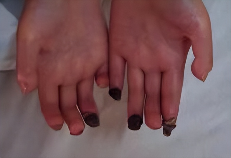 风湿免疫类疾病最怕什么,风湿免疫疾病如何预防