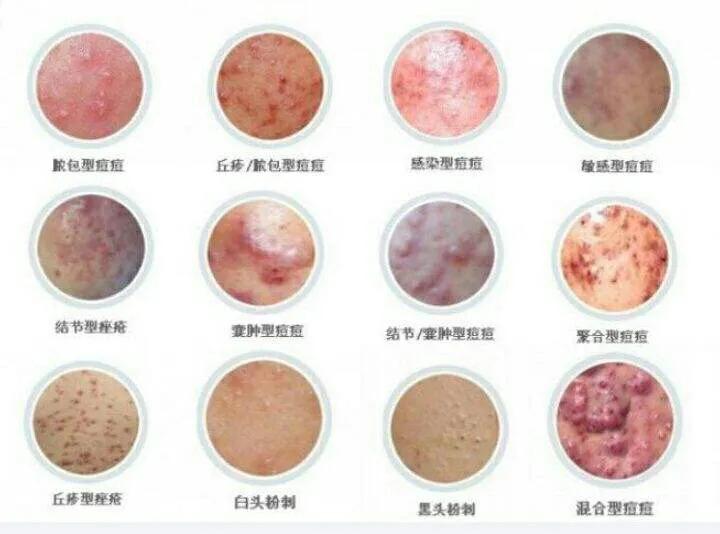 疱疹的中医辨证论治,疮的中医辨证论治