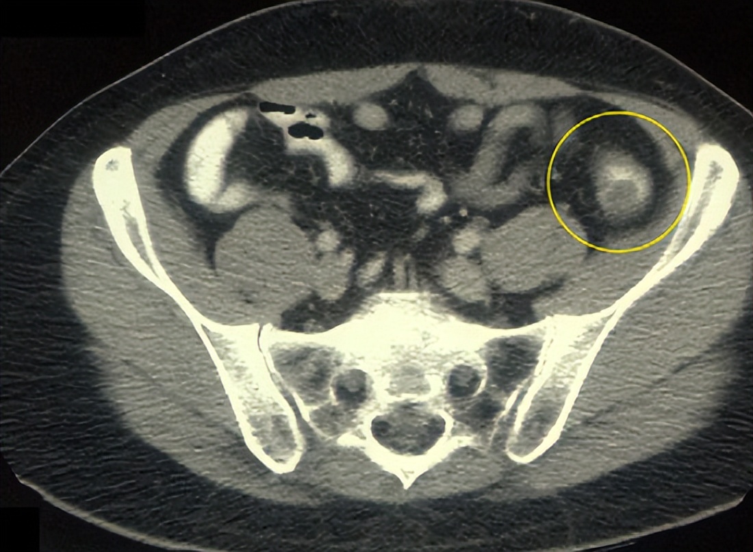 什么是肝实质性占位,什么情况肝占位需要做手术