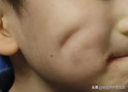 疤痕修复一次需要多少钱,上海九医院疤痕修复价目表2021