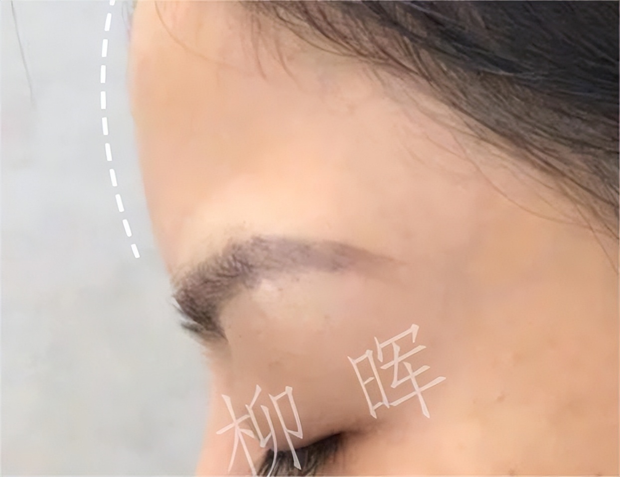 玻尿酸打额头的方法,玻尿酸打鼻子山根变宽真实案例