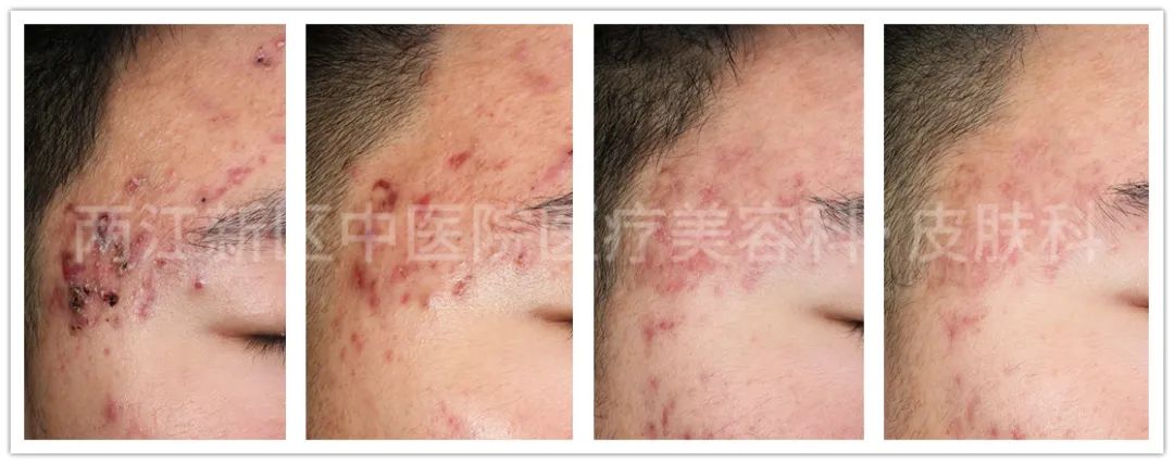 您想知道的“刷酸”知识都在这儿！