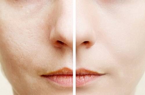 毛孔粗大和毛孔不粗大对比,毛孔粗大到底怎么样才能收缩毛孔