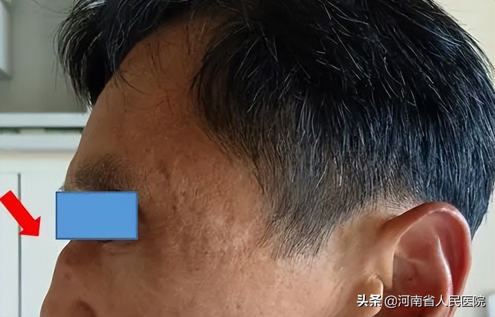 河南省人民医院“中德连线”建立！为疑难肺间质病患者会诊