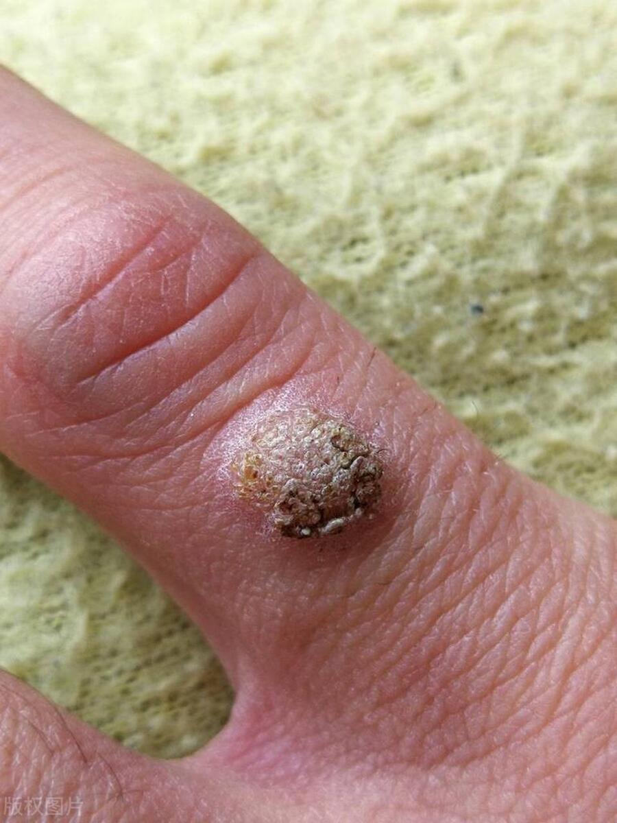 hpv感染有什么症状女士,女性怎样判断感染了hpv的症状