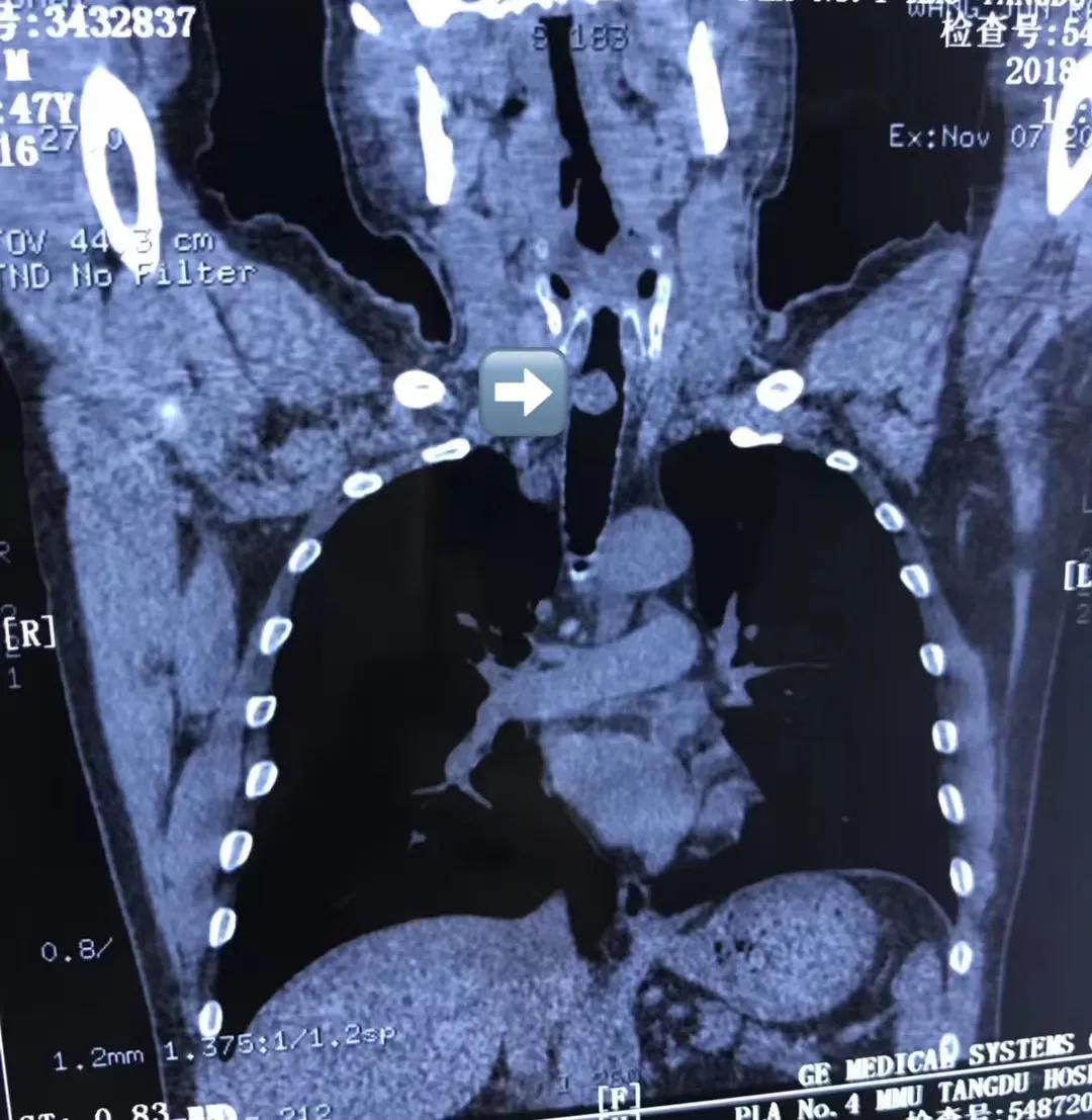 上气道狭窄治疗,气道狭窄致命吗