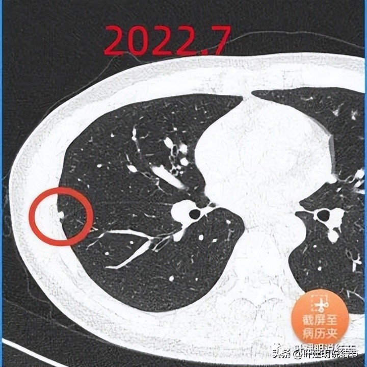 肺部结节医生建议抗炎后复查,放射科医生查出肺结节