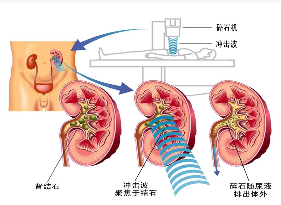 儿童有肾结石,儿童多发性肾结石