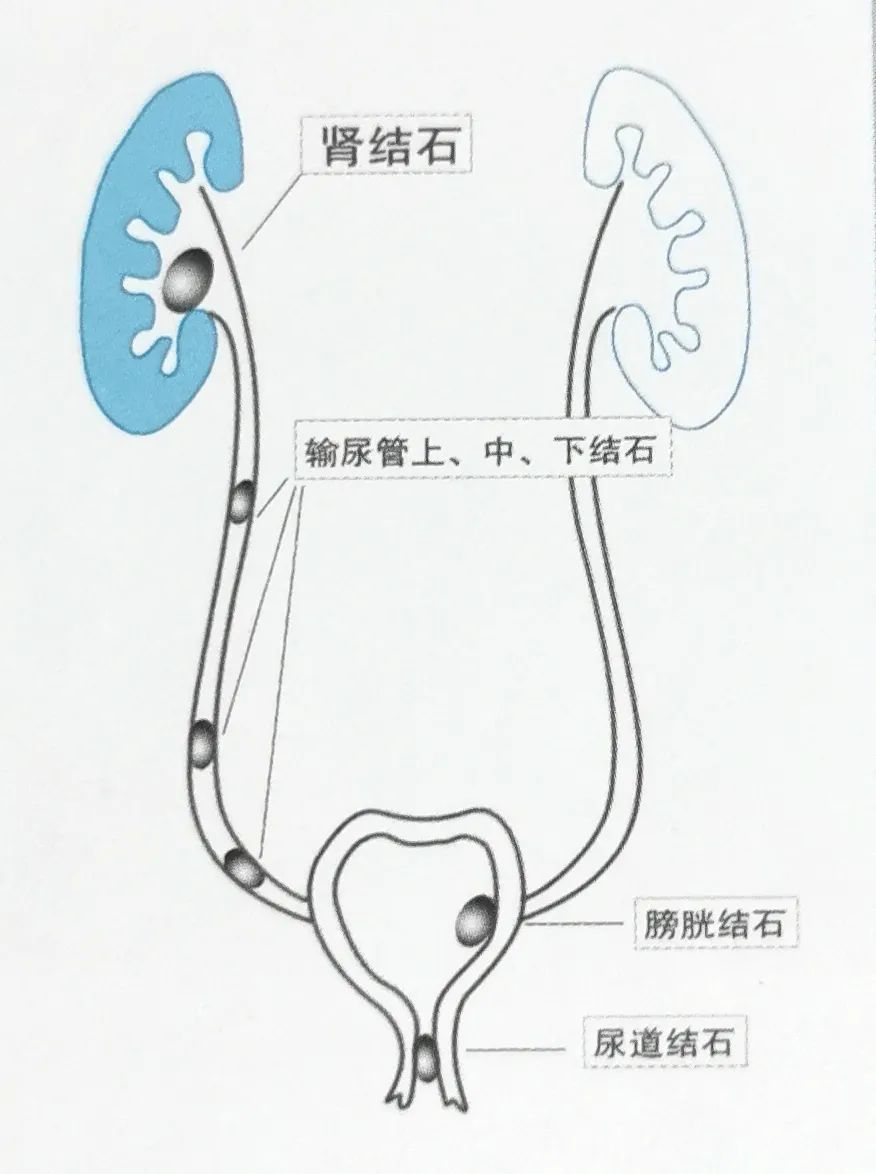 输尿管结石体外碎石多久能排出来,为什么做了体外碎石不尿血