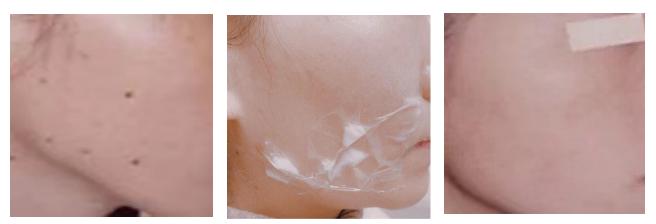 用药水点痣和激光祛痣哪个更安全,抖音上祛痣一擦就掉了是真的吗