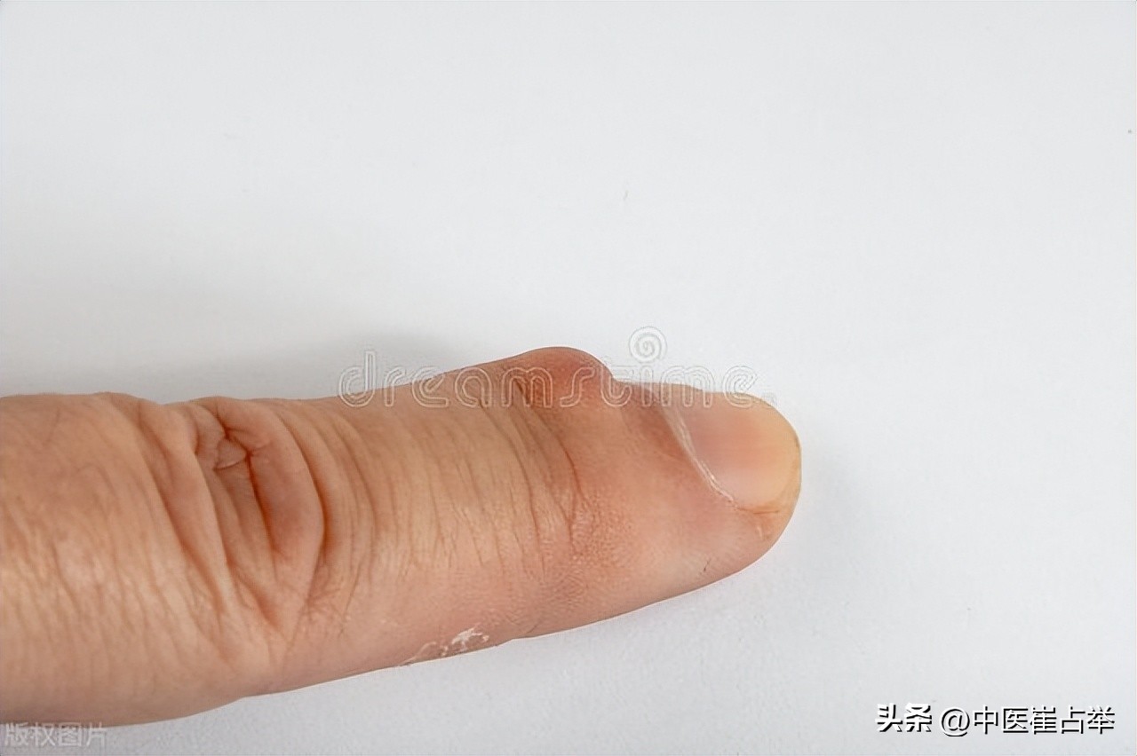 增生结节息肉囊肿这些怎么调理,身体有结节囊肿息肉吃什么中成药