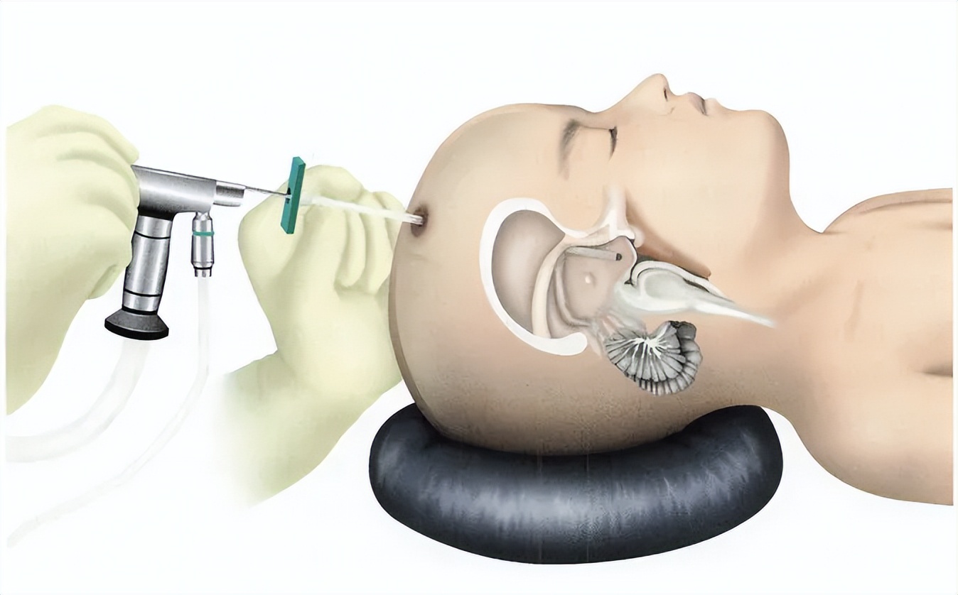 医生一转遥控器,我脑袋里的水就自动流进了肚子