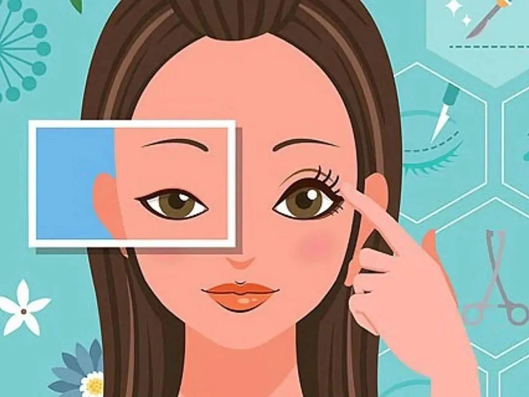 肿眼泡适合什么双眼皮手术,内双适合做双眼皮手术吗