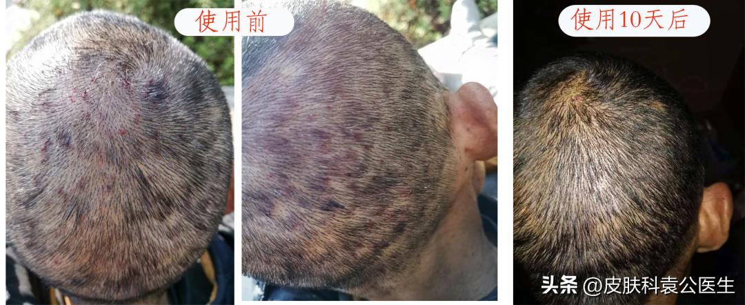 靶向加免疫治疗皮疹怎么处理,服用靶向药起皮疹怎么办