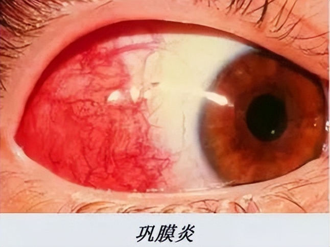 眼干眼涩眼模糊不清吃啥药,眼干眼涩看不清怎么治