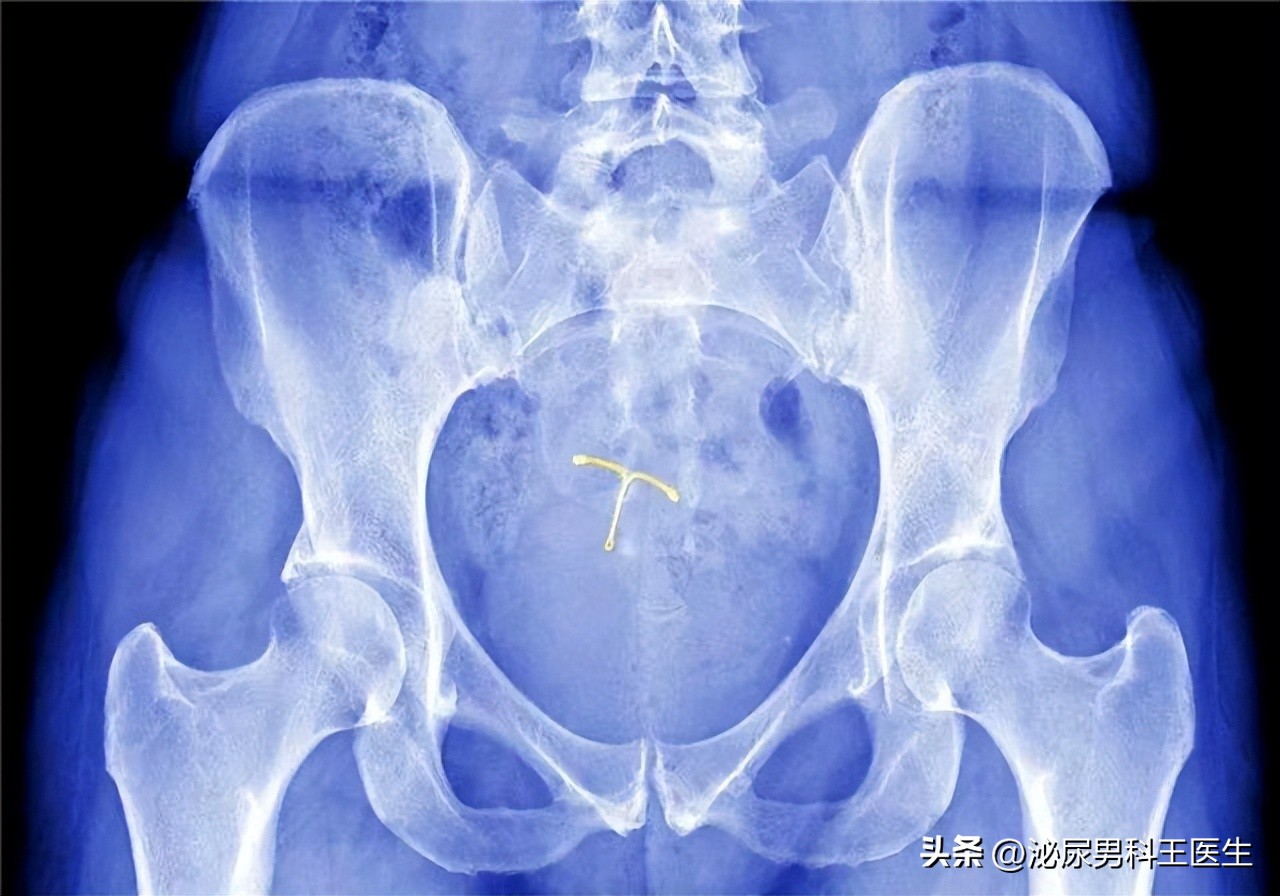 节育环多大年龄取出好取,节育环一直不摘