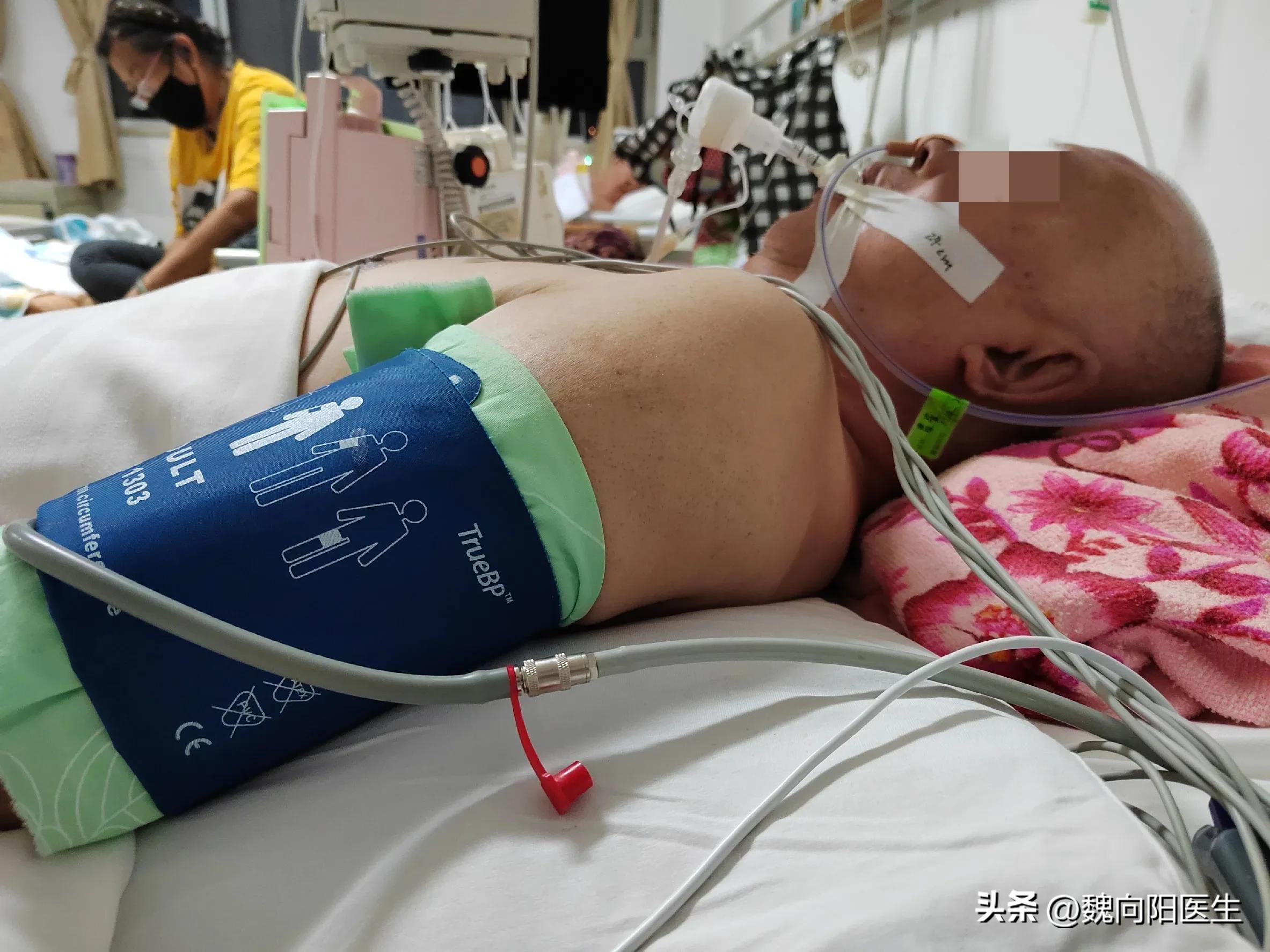 有可能治成“活死人”的脑出血患者，选择治和不治，都是正确的