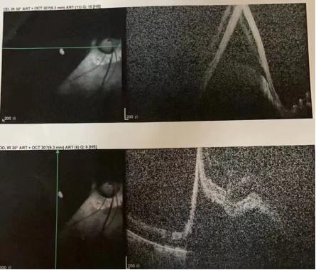 视网膜脱落找不到怎么办,视网膜脱落不能手术怎么办