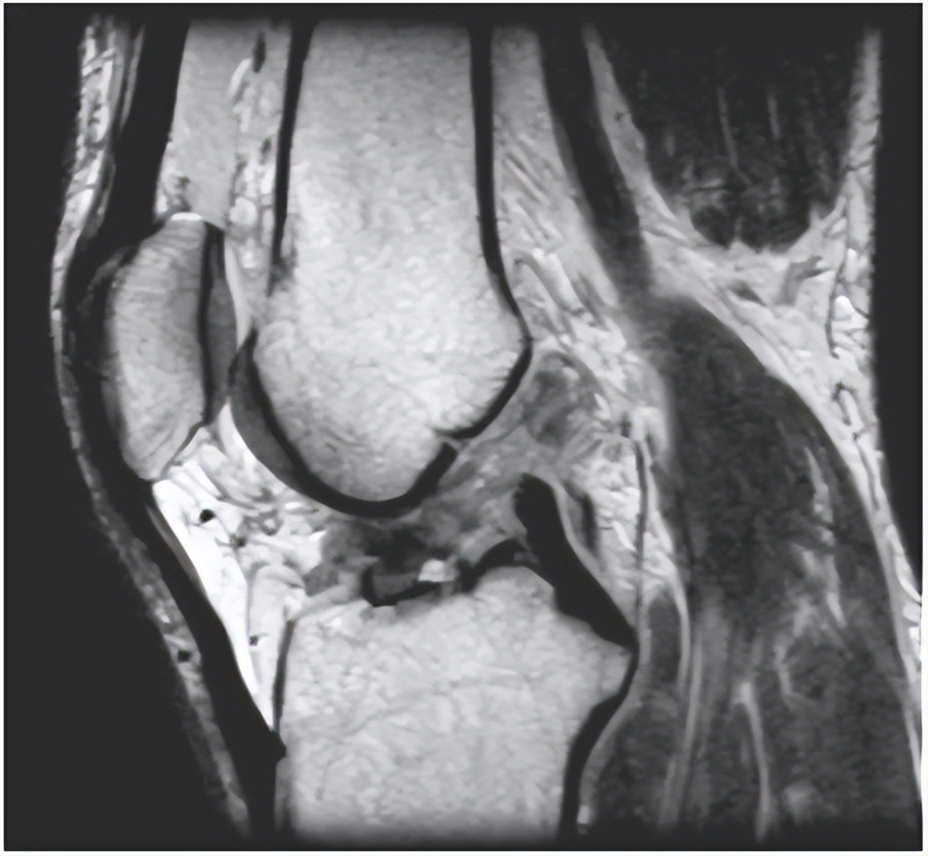 膝关节核磁有积液怎么看,核磁检查结论膝关节少量积液