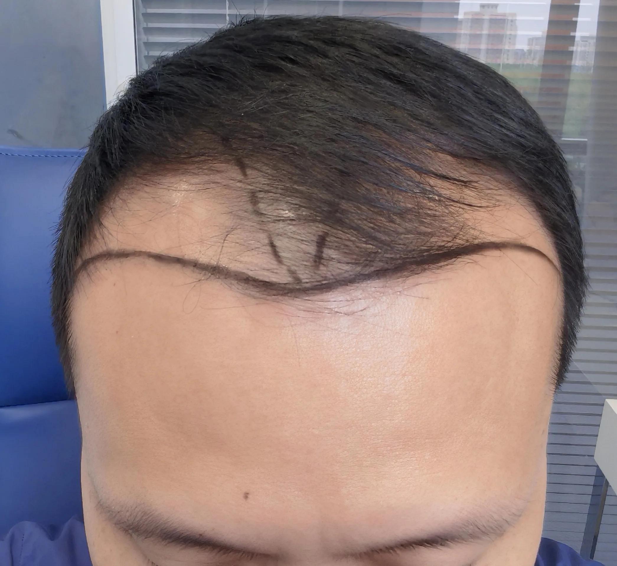 男士植发过来人真实感受,16000字讲述植发真实感受