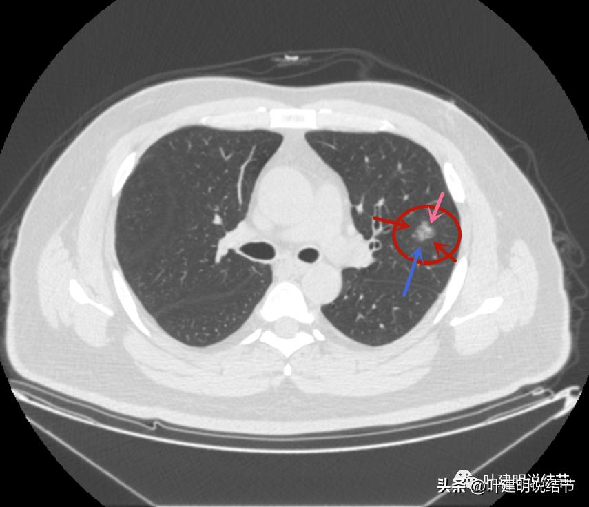 如何判断肺磨玻璃结节是高危结节,肺上有混合磨玻璃结节要注意什么