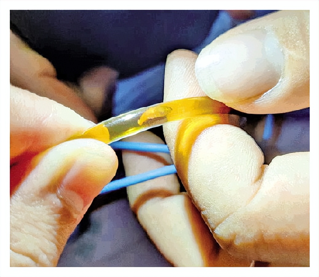 小伙痴迷生鱼片胆内发现寄生虫!专家建议,进食鱼虾应煮熟煮透