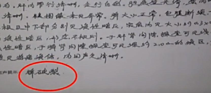 姑娘参加体检发现左肾丢失,陕西女子体检时发现左肾离奇消失