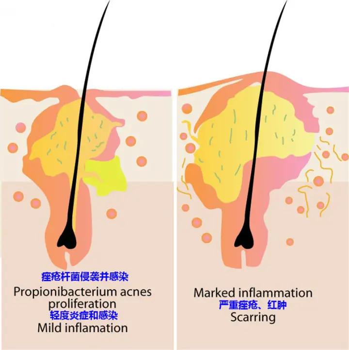 抗痘推荐22岁,青年人痘痘怎么治
