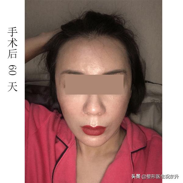 为什么第二次拉皮后法令纹更深了,拉皮手术后多久可以做法令纹填充