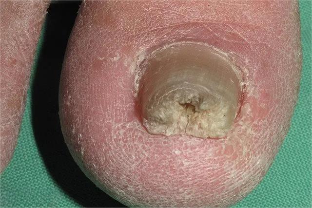 甲癣不严重怎么治疗,甲易生治疗灰指甲吗