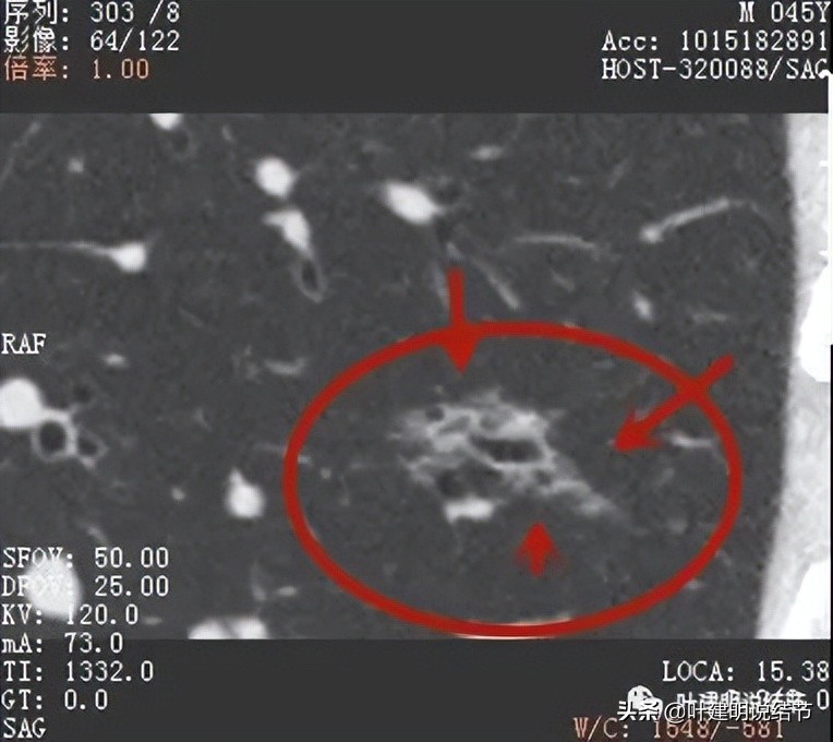 肺蜂窝状改变是肺癌吗,肺部陈旧灶与肿瘤怎么确诊