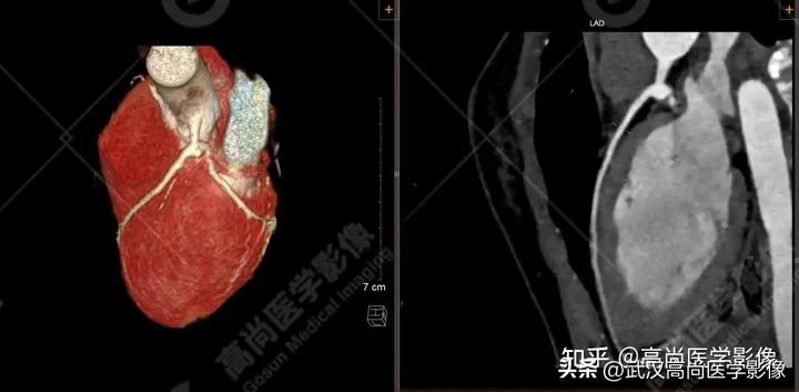 超声心动图可以用来诊断川崎病吗,心脏川崎病cta