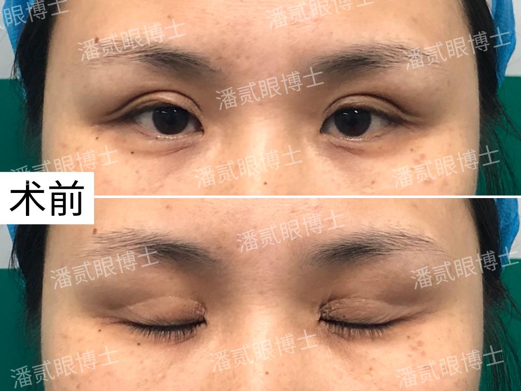 东莞整形做双眼皮,东莞整形医院割双眼皮