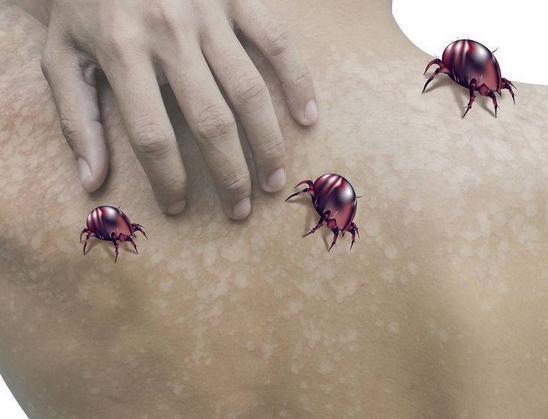 被子有螨虫怎么办,被子有螨虫怎么解决