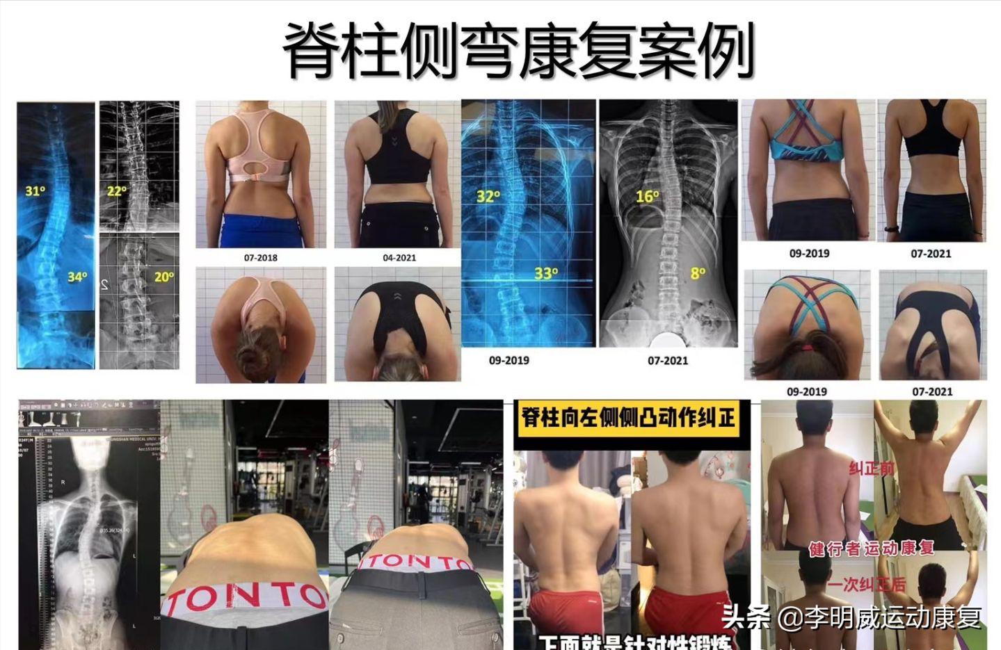 14岁脊柱向左侧弯13度要怎么矫正,14岁脊柱侧弯40度不治疗会加重呀