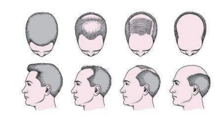 脂溢性脱发应该如何改善,脂溢性脱发怎么有效改善