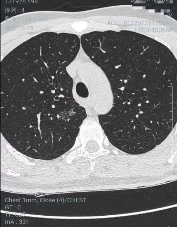 磨玻璃结节9*8mm建议随访,8mm磨玻璃结节一年没长