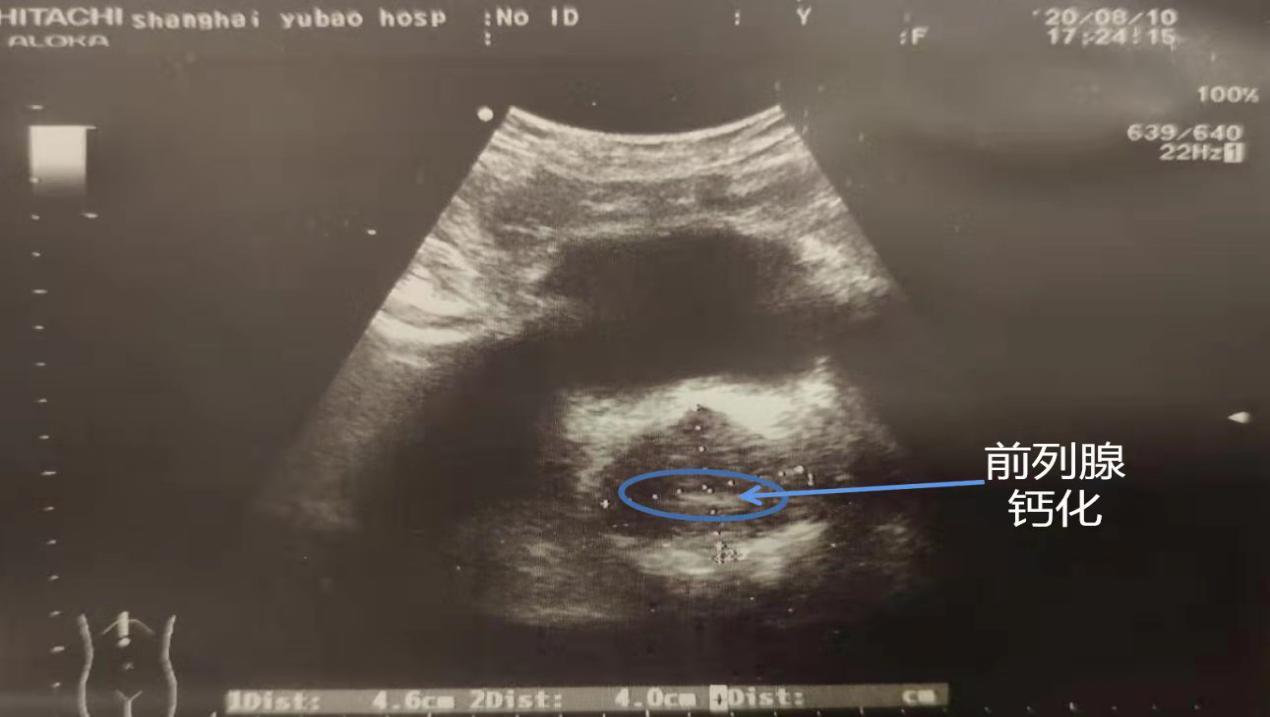 男人前列腺钙化怎么回事,前列腺钙化对男人有什么影响