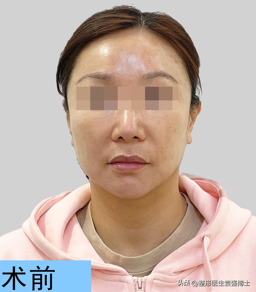 44岁女士拉皮除皱,50岁女人面部拉皮