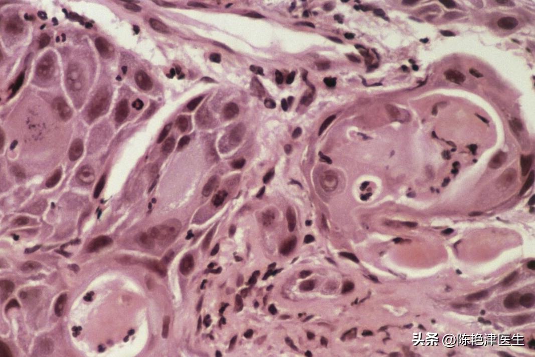 赵忠祥鳞状细胞癌早期症状,赵忠祥鳞状细胞癌有什么症状