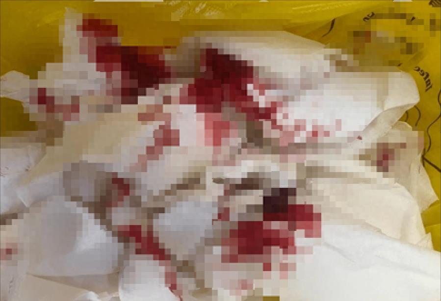 临终脱水、疼到痉挛，却被妻子强制插胃管，45岁丈夫呕出浓黑血液