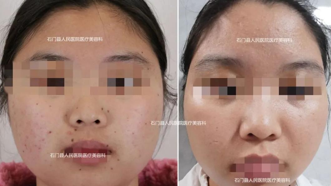 哪些痣应该点哪些痣不应该点,痣多适合什么点痣方法