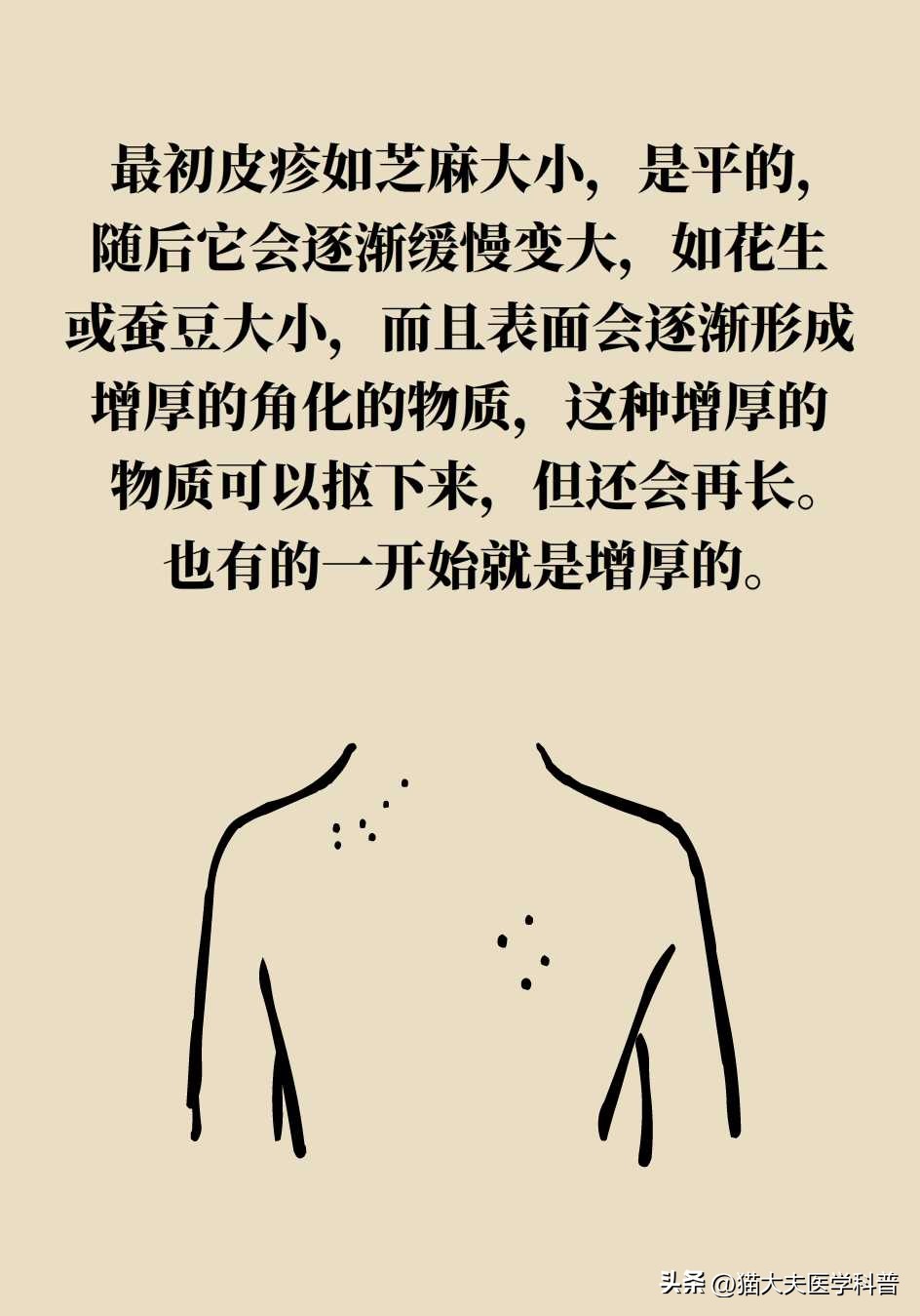 脖子上长的小肉揪怎么治啊,疣丝是不是脖子上的小肉粒