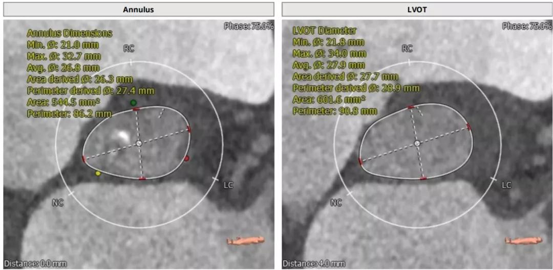 病例回顾与分享,腹膜后血肿介入治疗