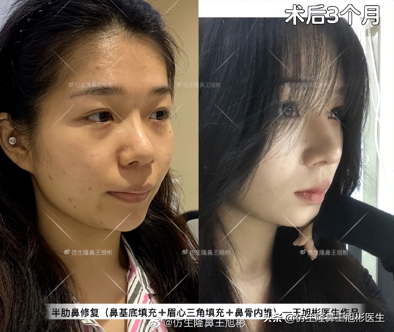 可以只做鼻头不放假体吗,只做鼻头鼻翼缩小手术多少钱