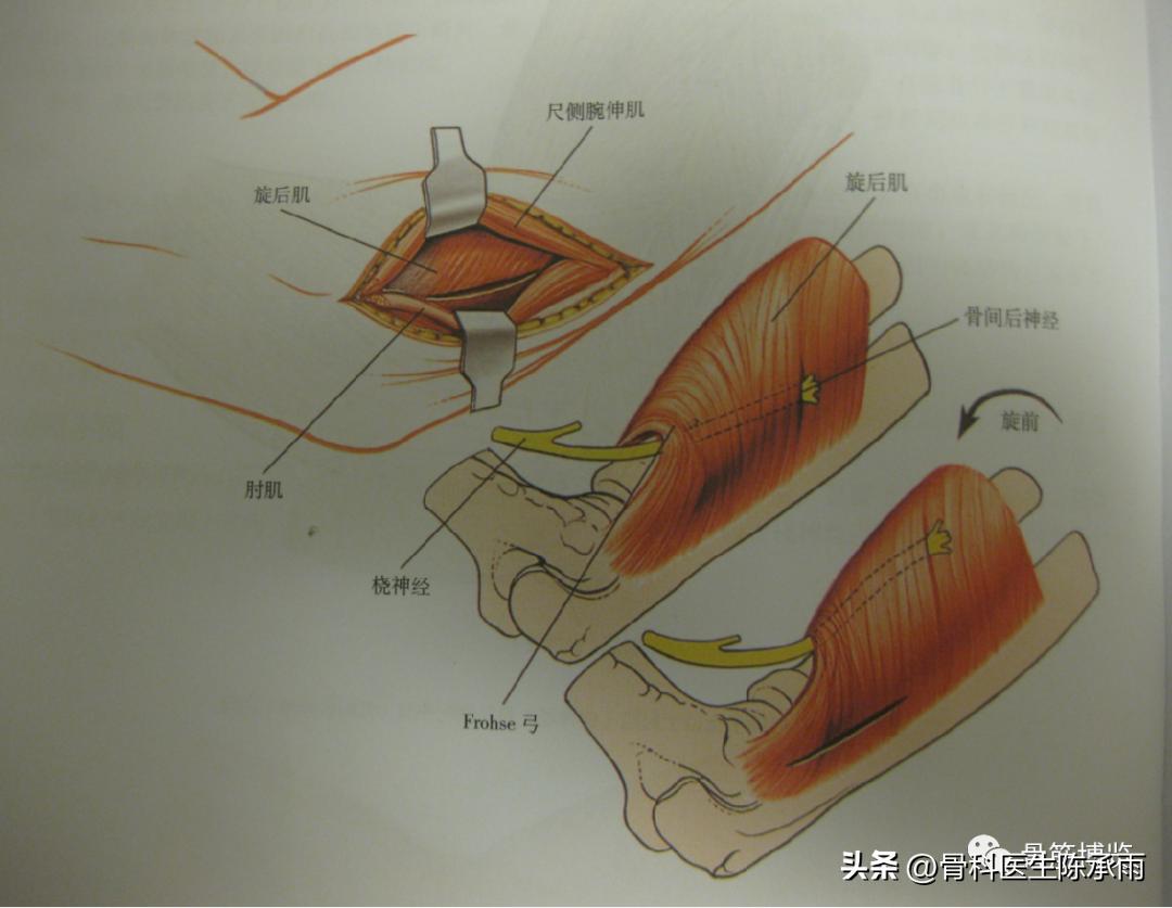 肘关节恐怖三联征最新治疗方法,肘关节恐怖三联征最佳治疗方法