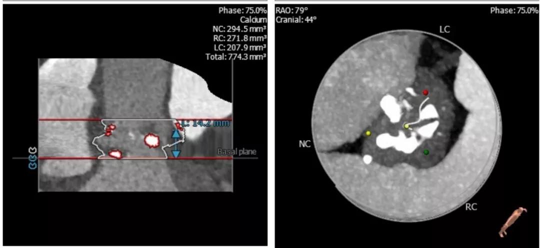 病例回顾与分享,腹膜后血肿介入治疗