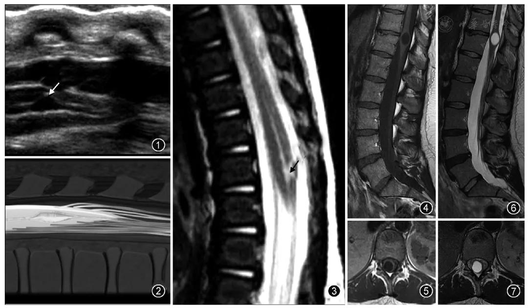 侧脑室就是透明隔腔吗,第五脑室是透明隔吗