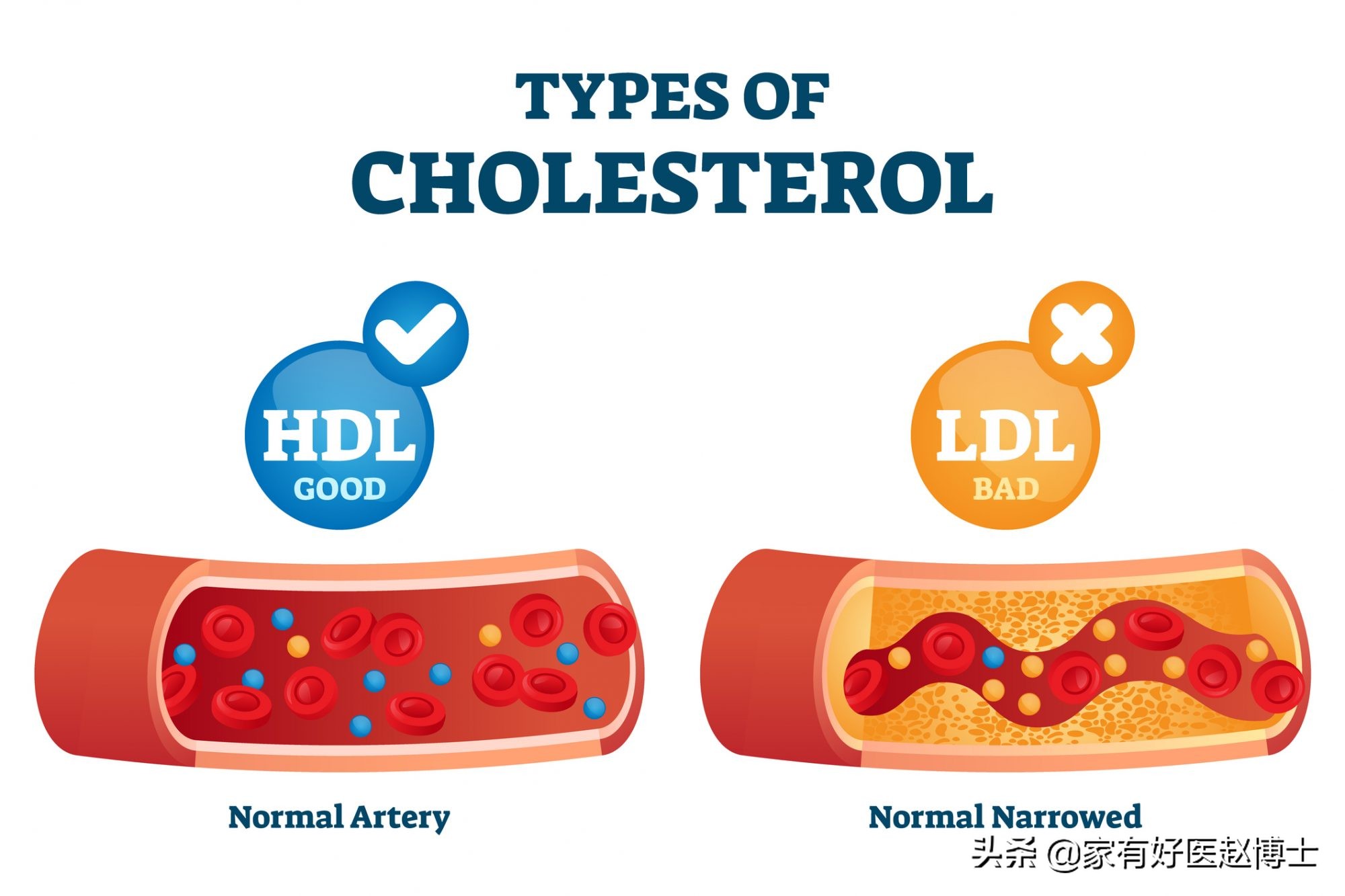 影响低密度脂蛋白胆固醇的因素,影响高胆固醇血症的因素
