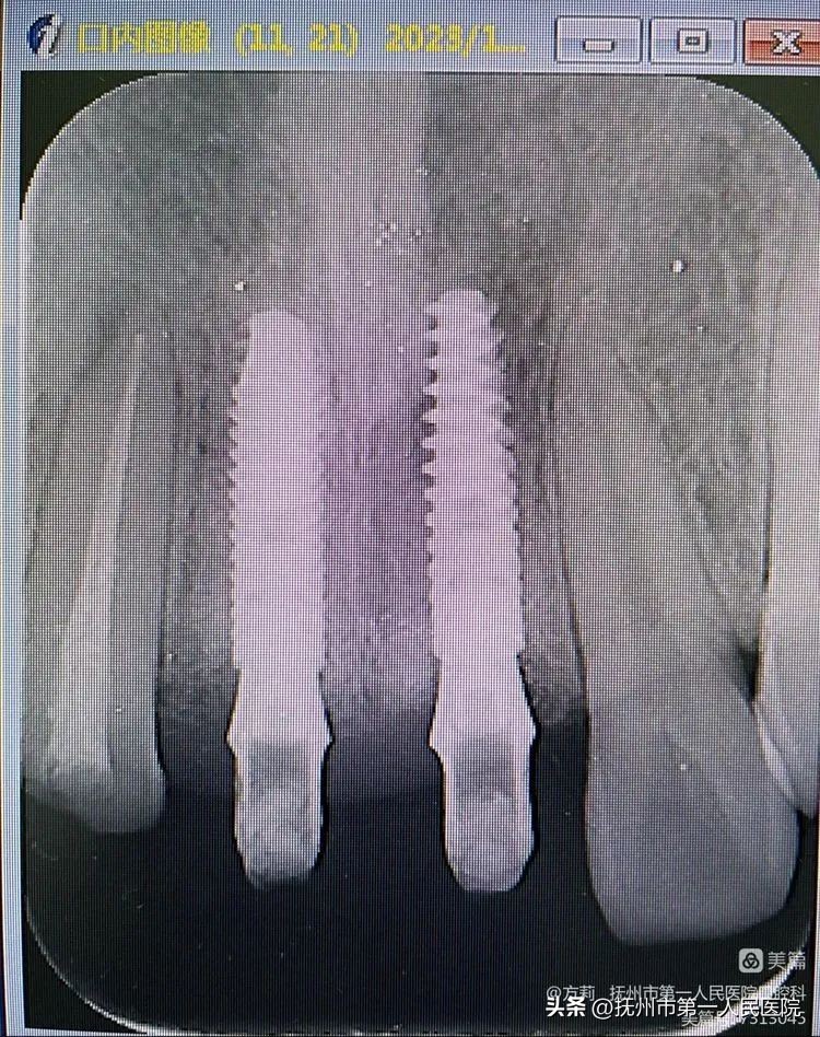 种植牙可修复多种牙齿缺失类型,学科建设口腔科